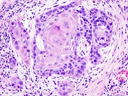 Histopathologic image illustrating well differentiated squamous cell carcinoma in the excisional biopsy specimen. Hematoxylin-eosin stain. (Image: Wikimedia Commons)