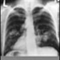 New rapid, inexpensive test can effectively identify never-smoking group with lung adenocarcinoma