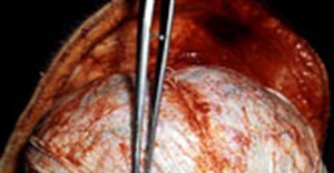 Autopsy: Brain surrounded by pus (the yellow-greyish coat around the brain, under the dura lifted by the forceps), the result of bacterial meningitis. A brain autopsy demonstrating signs of meningitis. The forceps (centre) are retracting the dura mater (white). Underneath the dura mater are the leptomeninges, which appear to be edematous and have multiple small hemorrhagic foci (red). (Image: Wikimedia Commons)