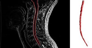 Cervical spine MRI with enhancement showing multiple sclerosis. (Image: Wikimedia Commons)