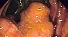 Endoscopy image of colon adenoca in sigmoid colon. Permission  obtained from patient to post in public domain. (Image:  Wikimedia Commons)