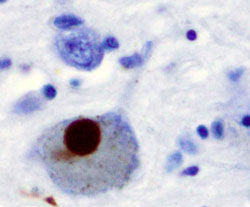 Dr. Schlossmacher and his colleagues have found the first link between the most common genetic factors for Parkinson’s disease and the hallmark accumulation of a protein called alpha-synuclein within the brains of people with the disease. Image shows alpha-synuclein stained in brown in the brain of an individual with Parkinson’s. (Image: Wikimedia commons)