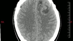 Brain tumour glioblastoma - transverse plane. (Image: Llorenzi, via Wikimedia Commons)