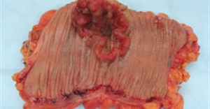 Colorectal cancer, gross appearance of an opened colectomy specimen. (Image: Emmanuelm at en.wikipedia)