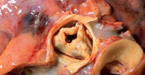 Gross pathology of rheumatic heart disease: aortic stenosis.  Aorta has been removed to show thickened, fused aortic valve  leaflets and opened coronary arteries from above. Autopsy.  (Image: CDC/Dr. Edwin P. Ewing, Jr, via wikimedia commons)