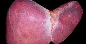 The human liver. (Image: Mikael Häggström, via Wikimedia Commons)