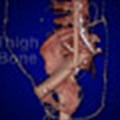 Ohio State surgeons rebuild pelvis of cancer patient