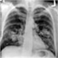 Study shows effective method of lung cancer screening