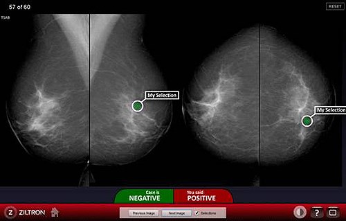Figure 1. Screenshot of the BREAST assessment system. In this case the user diagnosed cancers in a normal case. In practice this may result in an unnecessary and expensive biopsy procedure and significant stress to the patient.