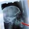 Non-cancerous brain tumors linked to frequent dental X-rays
