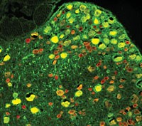 This image shows yellow/orange stained neurons that have been repaired by gene therapy while remaining neurons appear red. The novel technique dramatically reduced pain in animal models and is a potential treatment for hard to treat neuropathic pain associated with diabetes and nerve damage.