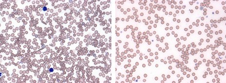 The image on the left is from a mouse that is normal. The image on the right is from a mouse treated with chemotherapy. The two blue cells are white blood cells; the red cells are red blood cells.