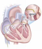 World's first non-surgical closure of leaking heart valve