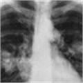 New research to revolutionise understanding of lung cancer