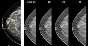 On the left: conventional 2-D mammography shows a potential lesion. The four 3-D tomosynthesis images to the right show there is no lesion present. (Image courtesy of Hologic, Inc.)