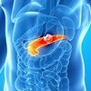 Long-term use of aspirin may reduce risk for pancreatic cancer