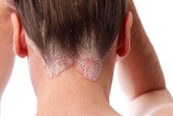 Help shed the stigma of psoriasis