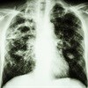 Approval by MCC of new TB drug welcomed