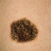 Managing melanoma, early detection could save your life