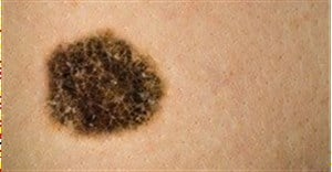 Managing melanoma, early detection could save your life