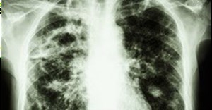TB or no TB, new treatment for drug resistant strain