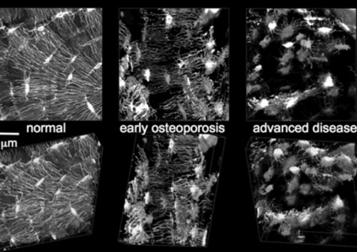 The imaging technique showing early and advanced osteoporosis. (Image: Supplied)