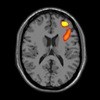 The adolescent brain develops differently in bipolar disorder