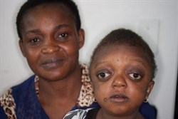 Akikere and her mother before the surgery.
