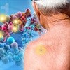 Yale study identifies 'major player' in skin cancer genes