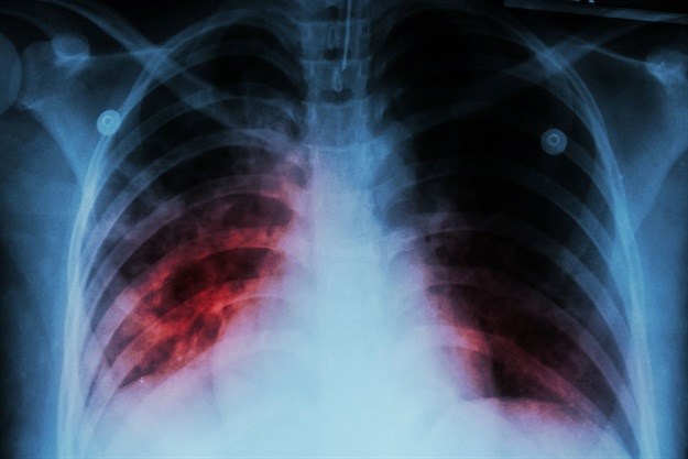 Blocking TB vitamin production may be key to treatment