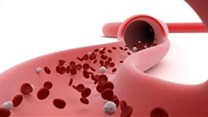 Researchers link lipids to one third of myelomas