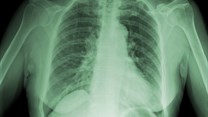 #TBDay: Keeping TB on the nation's health radar