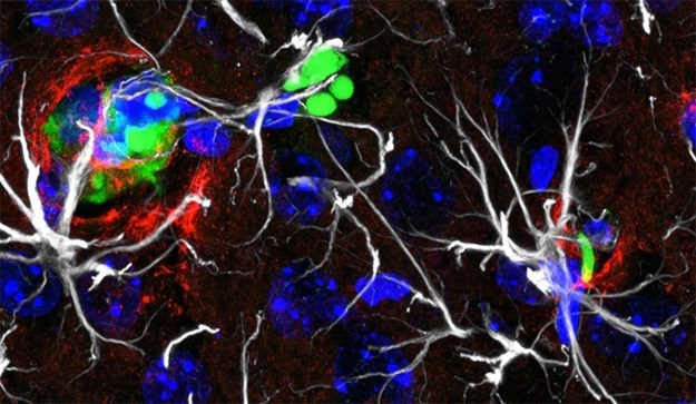 Soon after lung cancer cells (in green) spread into the brain, extracellular matrix molecules (in red) can shield them from the hostile surroundings.