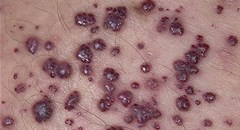 Fabry disease is treatable, so early diagnosis is critical