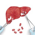 Non-invasive scan for liver disease