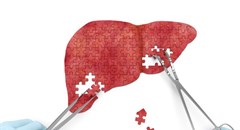 Non-invasive scan for liver disease