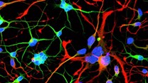 Huntington’s neurons show multiple nuclei (blue) within the same cell, and other signs of trouble, long before symptoms emerge.