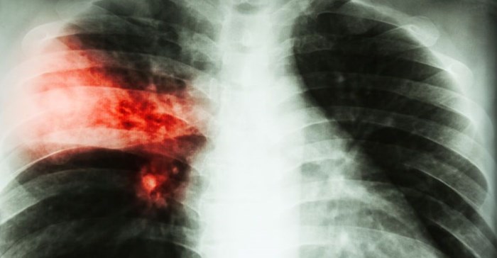 Groundbreaking settlement in silicosis/TB class action