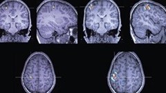New technique fine-tunes treatment for severe epilepsy cases