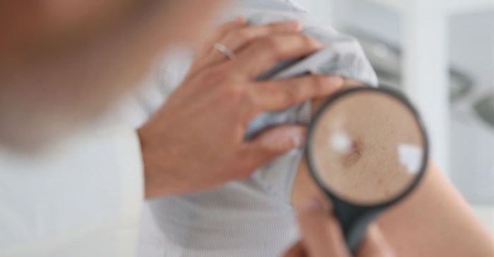 Common skin cancer can signal increased risk of other cancers