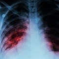 New tactics needed to eliminate TB