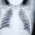 X-ray of the lungs in a 5-year-old child who has pneumonia. Shutterstock