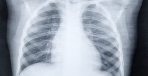 X-ray of the lungs in a 5-year-old child who has pneumonia. Shutterstock
