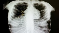 Around 18% of previously treated TB cases are drug resistant. Shutterstock