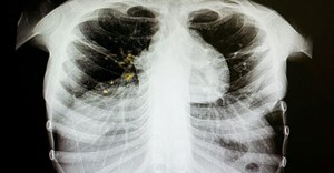 Around 18% of previously treated TB cases are drug resistant. Shutterstock
