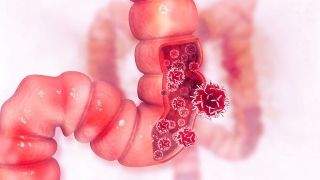 Starting colorectal cancer screening at 45 would avert deaths