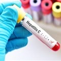 Hepatitis is a major public health burden. Shutterstock