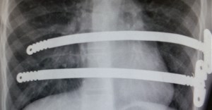 Workshop emphasises benefits of Nuss procedure for sunken chest deformity