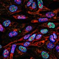 Tumour cells under a microscope labelled with fluorescent molecules. Shutterstock