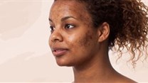 Different types of pigmentation and how to treat it